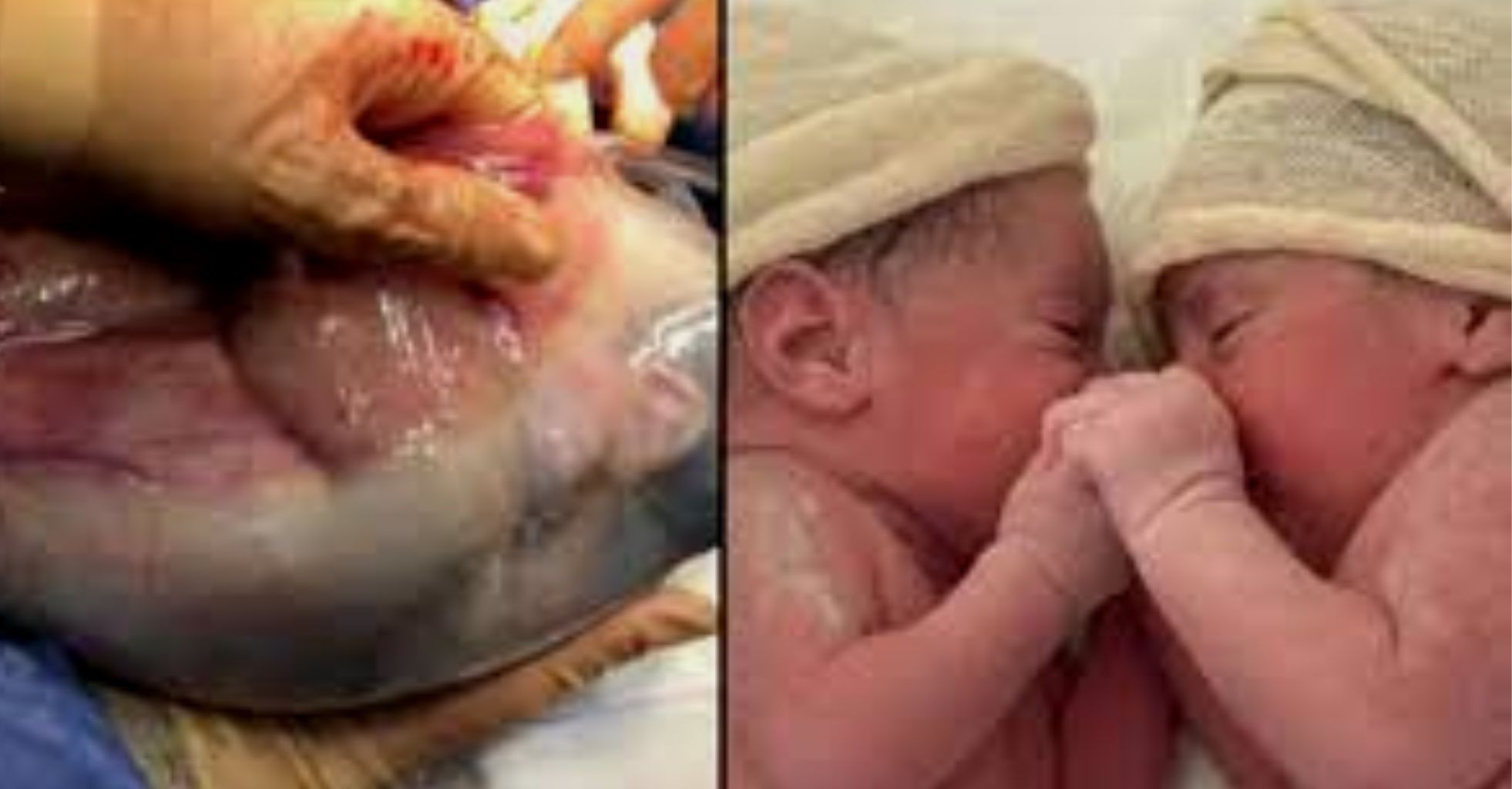 Twin born still inside amniotic sac in one-in-80,000 event